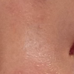 피부 여드름 피부과 안가고 좋아진 방법