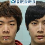 남자도<b>성형</b>해야하는구나ㅋㅋ(before&amp;after)