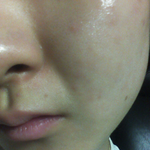 (혐오) 이게 여드름인가요 <b>피부염</b>인가요?ㅜㅠㅜ