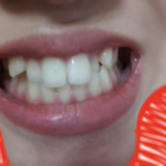 치아가 너무이상해요 <b>덧니</b>