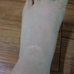 <b>발등</b>물혹수술하신분이나 이쪽으로 의료지식있으신분들 도와주세요ㅠㅠ....