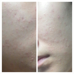 사진있음ㅠㅠ) 피부때문에 너무 고민이 많은 여중생입니다..