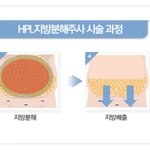 <b>울산</b> 라마르 <b>울산</b> 지방분해주사후기