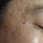 피부에 자꾸 여드름이 납니다...ㅠ 사진(<b>yes</b>), (토하지마세요)