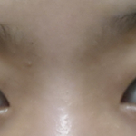 <b>눈수술</b> 해야될지좀 봐주세요