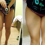 허벅지 지방<b>흡입</b> 후 6cm 줄어듬