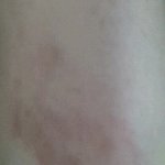 디팡다가 모두가 <b>피멍</b>들었어요ㅜ.ㅜ