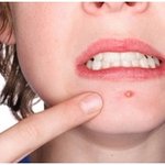 뾰루지 이제 한방에 정리하게됬어요..!!