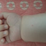 <b>수족구</b> 가볍게지나가는 애기도  있나요?