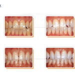 치아미백의 정의와 종류