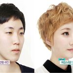 <b>렛미인</b>은 공짜로 수술 해주나요?