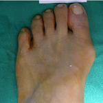 정형외과에서 <b>무지외</b>반증치료하나요? 정형외과잘하는곳좀...