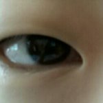 <b>짝눈</b>이 너무심해요ㅠ(쌍수 고민)