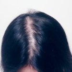 20대인데 탈모 시작됐네요...