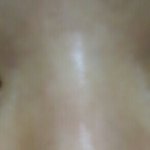 (사진ㅇ)찢어진 눈 <b>밑부분</b> 성형해야할까요?