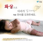 3살밖에 않된 아이가....<b>화상</b>으로 심하게 다쳤습니다...