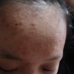 [공짜]여드름 피부이신분들만 보세요