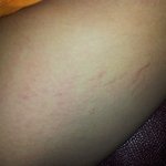 <b>허벅</b>지살이많이텄어요ㅠㅠ