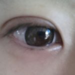 쌍수(이중매몰+비절개<b>눈매</b>교정) 붓기좀요 ..t-t