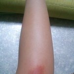 [틴탑] <b>님들</b> 모기물렷을때 긁지마셈