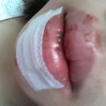 저기요 <b>입술</b>꼬맸는데 답변좀요ㅜ