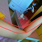 튼살 <b>문의</b>!!