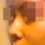 코 부작용 이정도면 심한거 아님? ㅡㅡ (사진有)