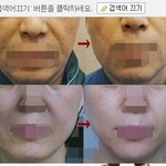 효과좋은 실리프팅얼굴 실리프팅효과 (<b>전후</b>사진있음)