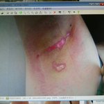 사진 有] 겨드랑이 제모 후 화상..