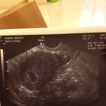 첫 임신.. 첫 심장 소리 <b>신기방기</b>