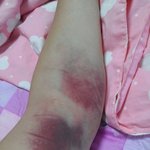 [어이없음] 수원 정형외과의 만행