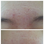 [댓글부탁] 여드름 잡는 양배추팩 후기! (사진추가!!)