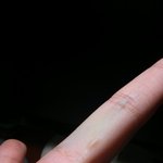 [도와주세요] <b>성냥</b>으로 불장난하다가 화상입엇는데