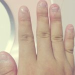 [손톱버릇] 28년만에 고친 손톱버릇