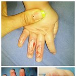 [도와주세요] 어린이집 화상사고 우리아이 손 좀 봐주세요