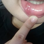입 안에 <b>구멍</b>? 너무아파요ㅠㅠ