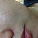 [알려주세요] <b>혐오</b>주의) 모공이 진짜 넓은데 효과볼만한 시술좀 추천