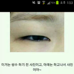 [쌍수] 쌍수해야하는이유 사진유!!!! <b>전후</b>사진