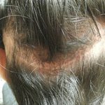 [꼭조언부탁] <b>모발</b>이식하고 인생 망쳤네요.... 부작용때문에..