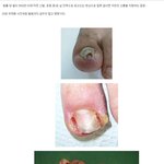 [<b>작두</b>] [극혐] 내향성 발톱