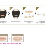 [꼭조언부탁] 모발이식 부작용... 내가 나를 죽일 수도 있는....