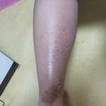 [조언부탁] 제 다리, <b>동상</b>걸린건가요??ㅠㅠㅠ급함