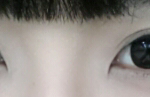 앞트임 해야될까요?