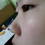 [댓글부탁] <b>코수술</b>을해야될까요???