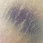 [억울해요] 주사 한방에 <b>피멍</b>. 과연 주사는 누가 놓았는가?