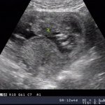 [오늘의톡] 임산부 버스안  창문 좀 열었다고 <b>벼슬</b>?