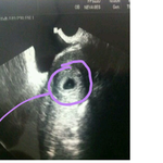 이거 임신 맞나요? 초음파 사진첨부요 여자분이 봐주면 좋구요