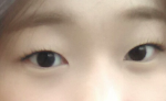 [조언부탁] 쌍커풀 수술 정말 고민됩니다 ㅠ