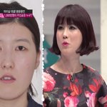 @ 양악수술은 이런 사람들에게 필요한 수술