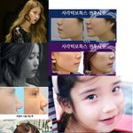 [<b>중딩</b>] 아이유성형
